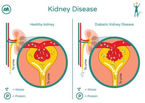 Diabetes and the Kidneys | Patient Navigator